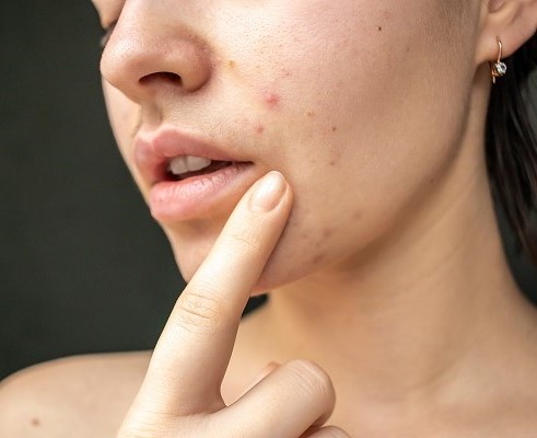 Behandlung für unreine Haut